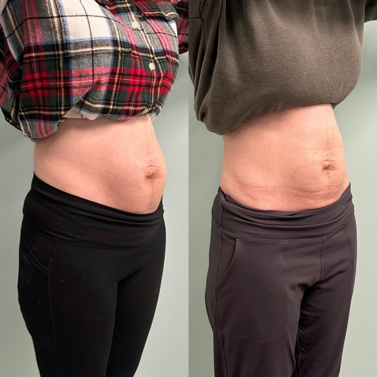 Emsculpt Before & After Gallery - Patient 572553 - Image 6