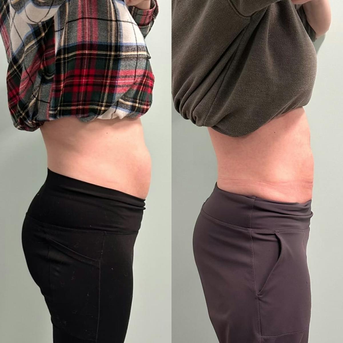 Emsculpt Before & After Gallery - Patient 572553 - Image 4