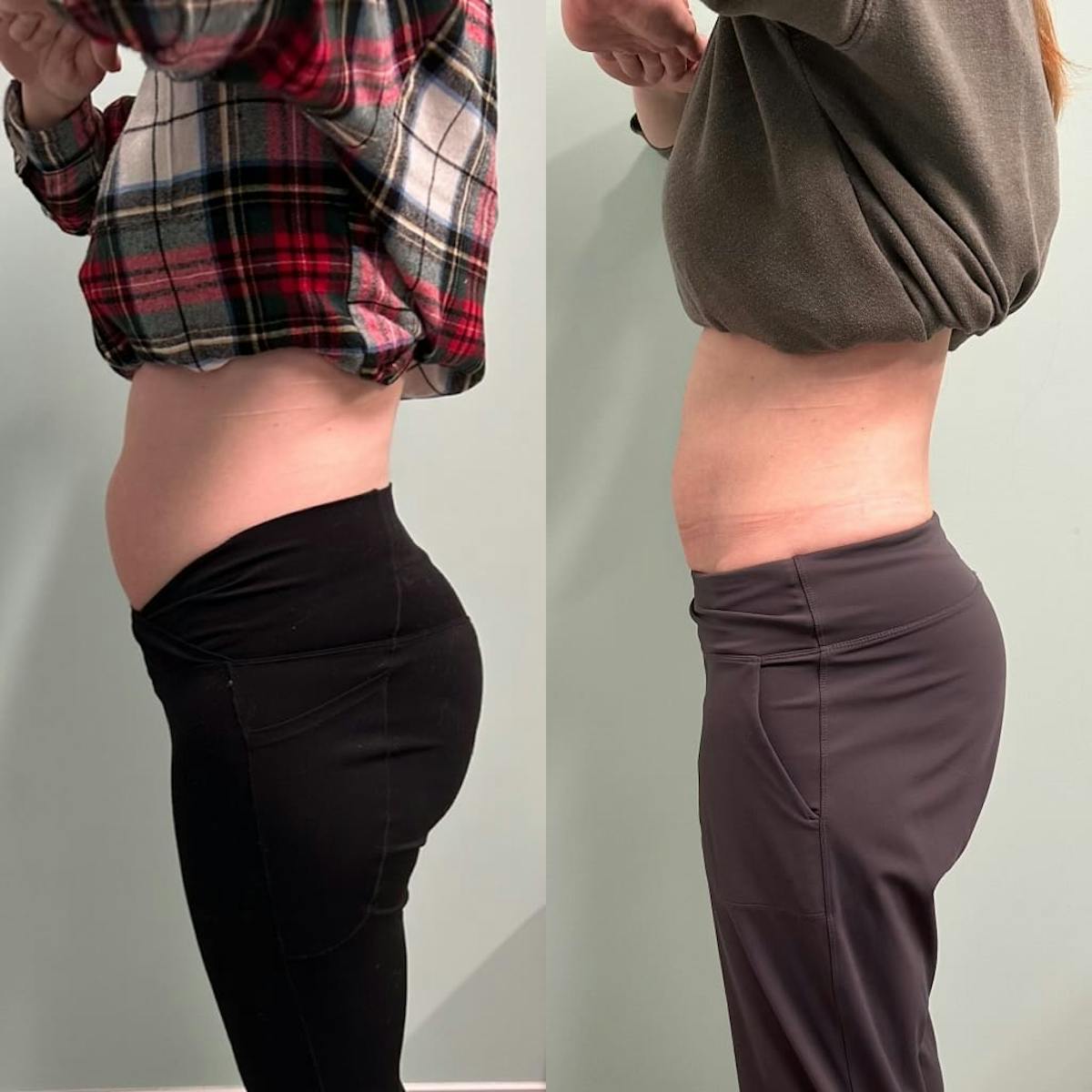 Emsculpt Before & After Gallery - Patient 572553 - Image 7