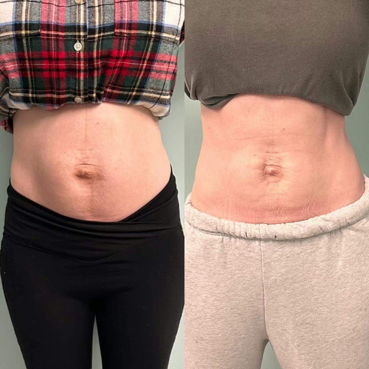 Emsculpt Before & After Gallery - Patient 572553 - Image 1
