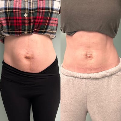Emsculpt Before & After Gallery - Patient 572553 - Image 1