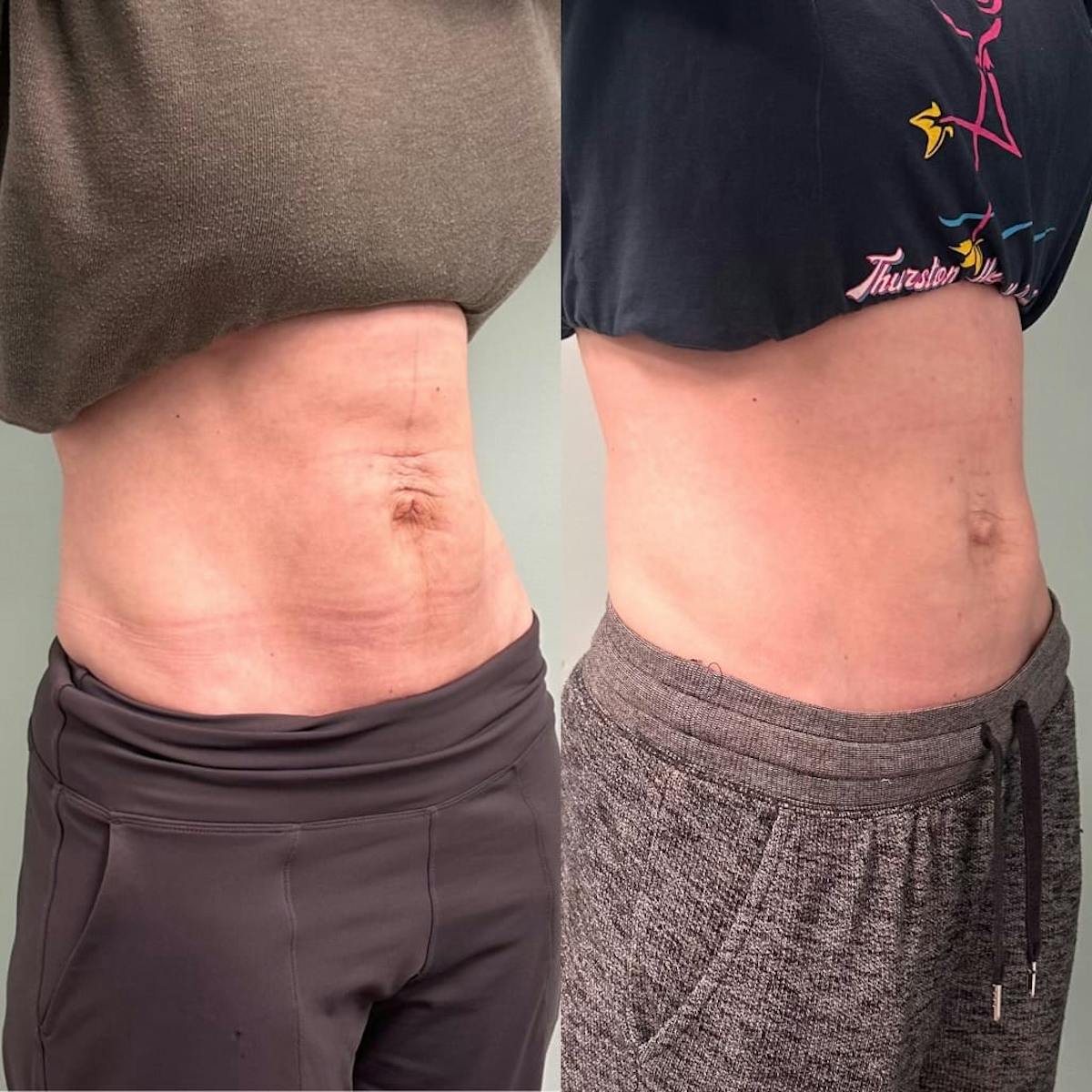 Emsculpt Before & After Gallery - Patient 572553 - Image 3