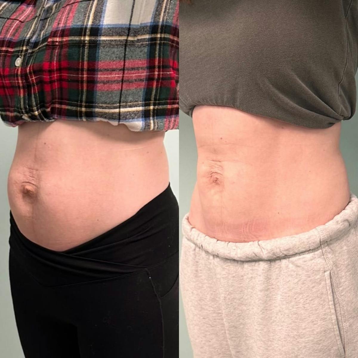 Emsculpt Before & After Gallery - Patient 572553 - Image 2