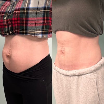 Thermage Before & After Gallery - Patient 165166 - Image 1