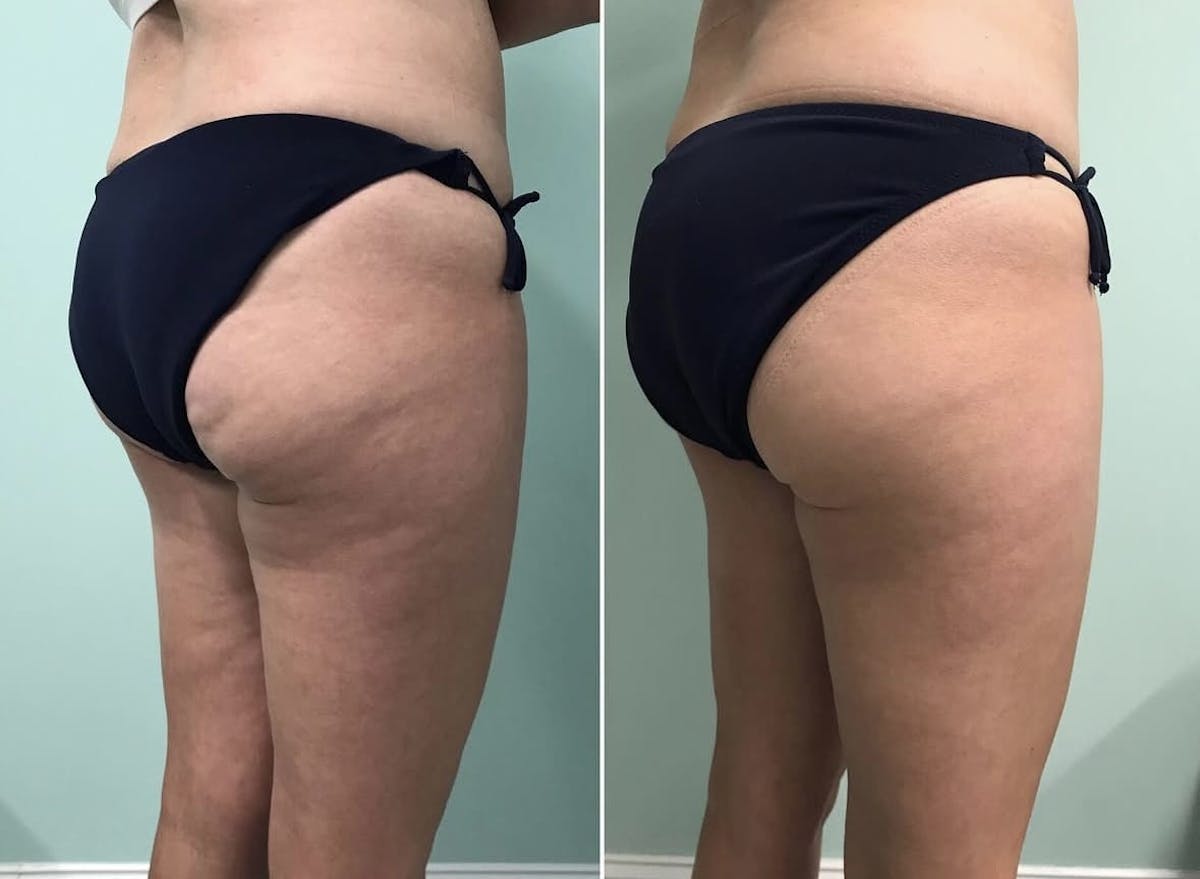 Emsculpt Before & After Gallery - Patient 366790 - Image 1