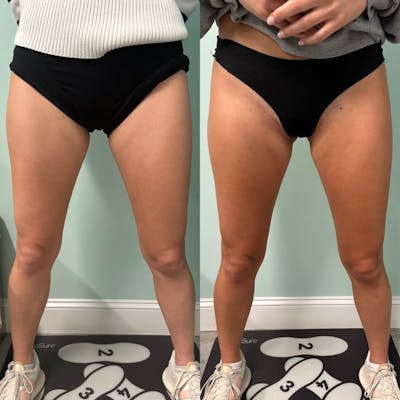 SculpSure Before & After Gallery - Patient 171701 - Image 1
