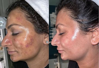 Anu Before & After Gallery - Patient 209978 - Image 1