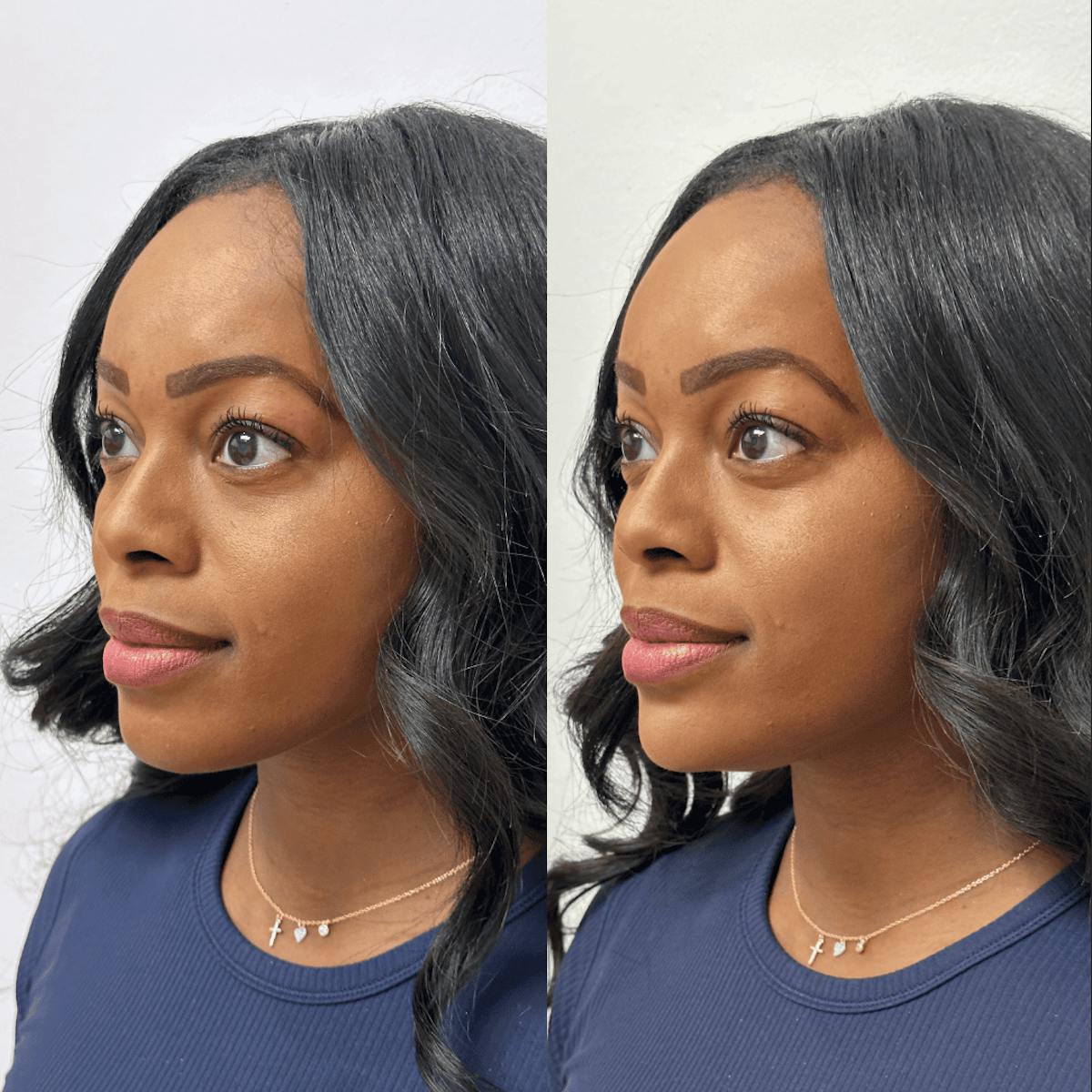 Chin Before & After Gallery - Patient 374974 - Image 2