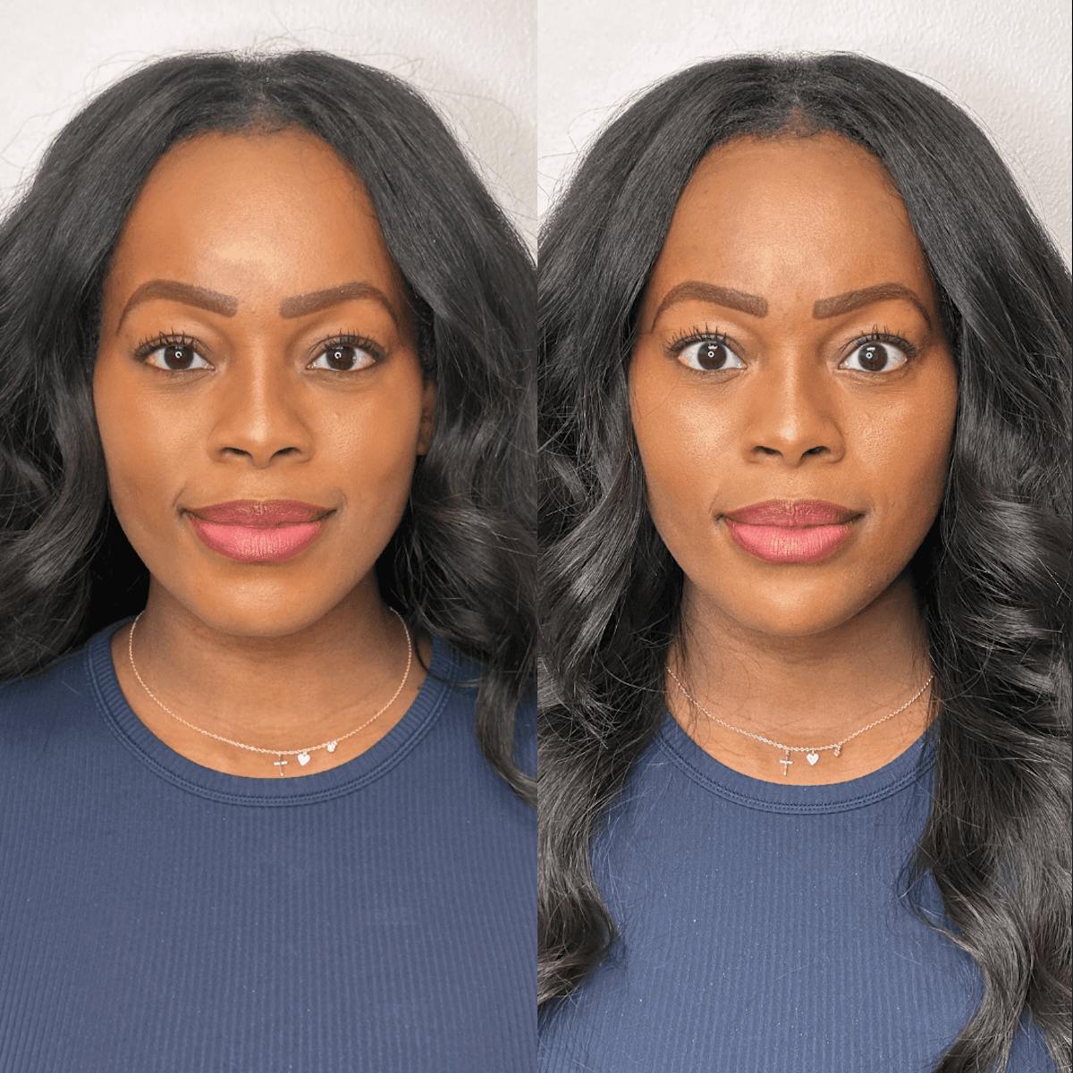 Chin Before & After Gallery - Patient 374974 - Image 4