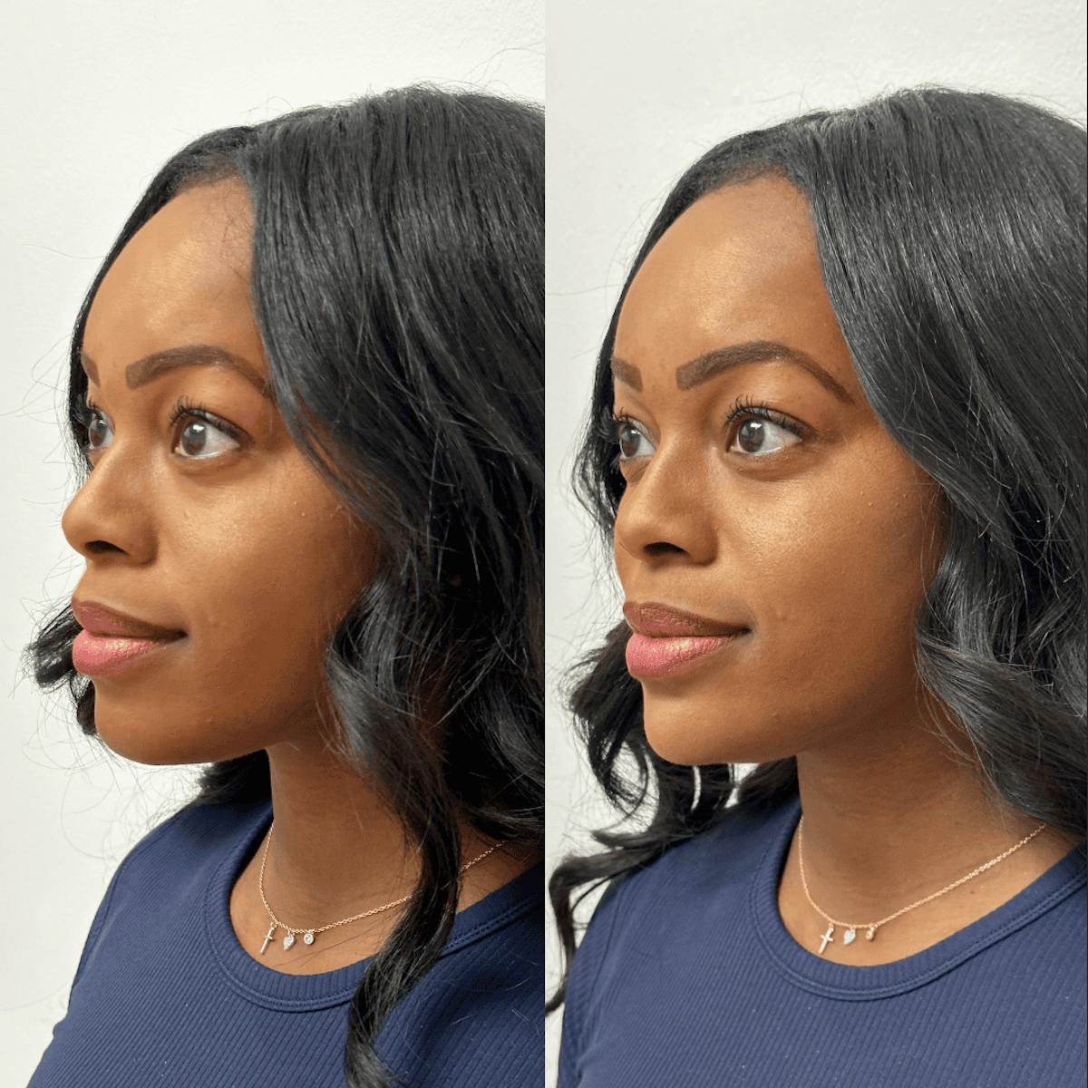 Chin Before & After Gallery - Patient 374974 - Image 3
