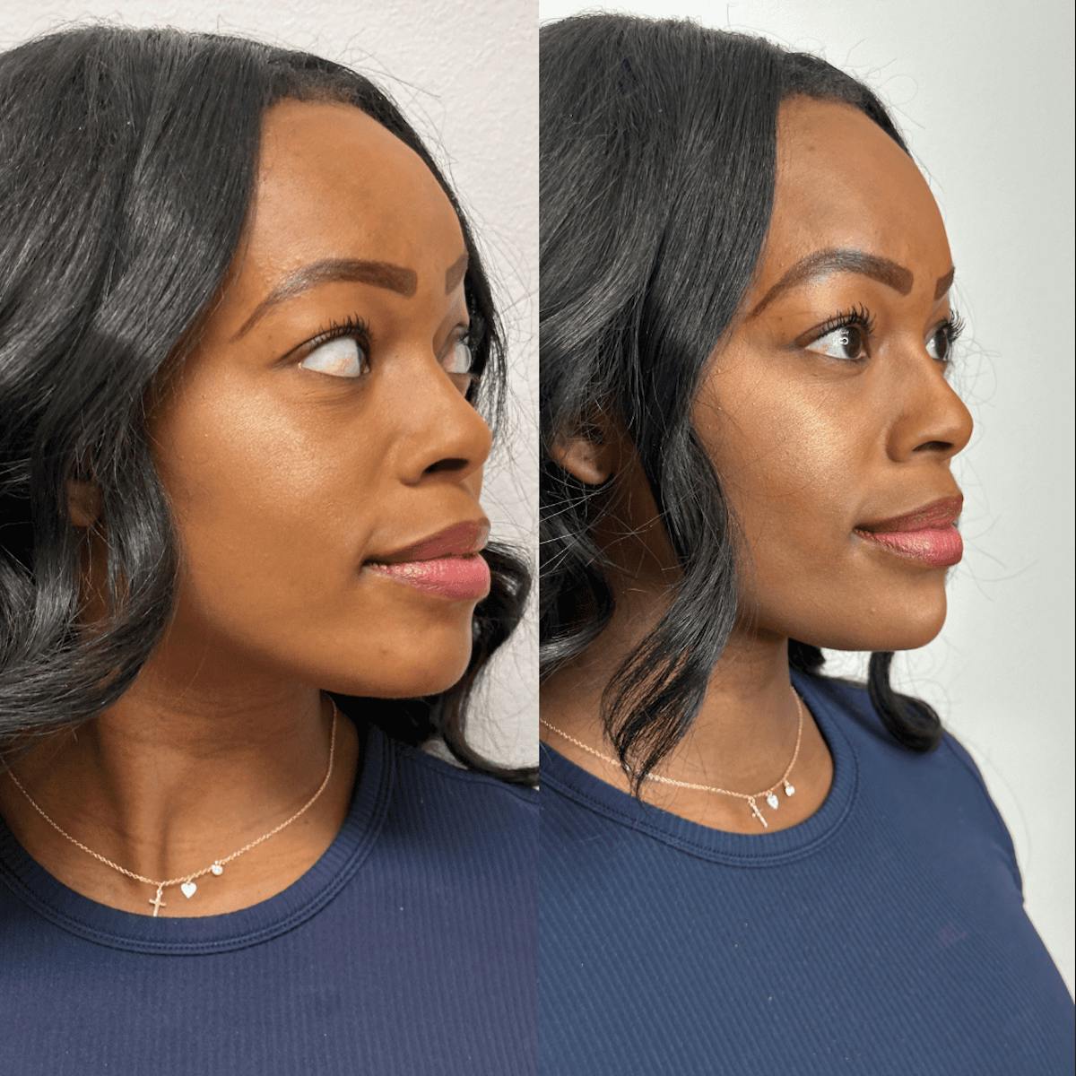 Chin Before & After Gallery - Patient 374974 - Image 8