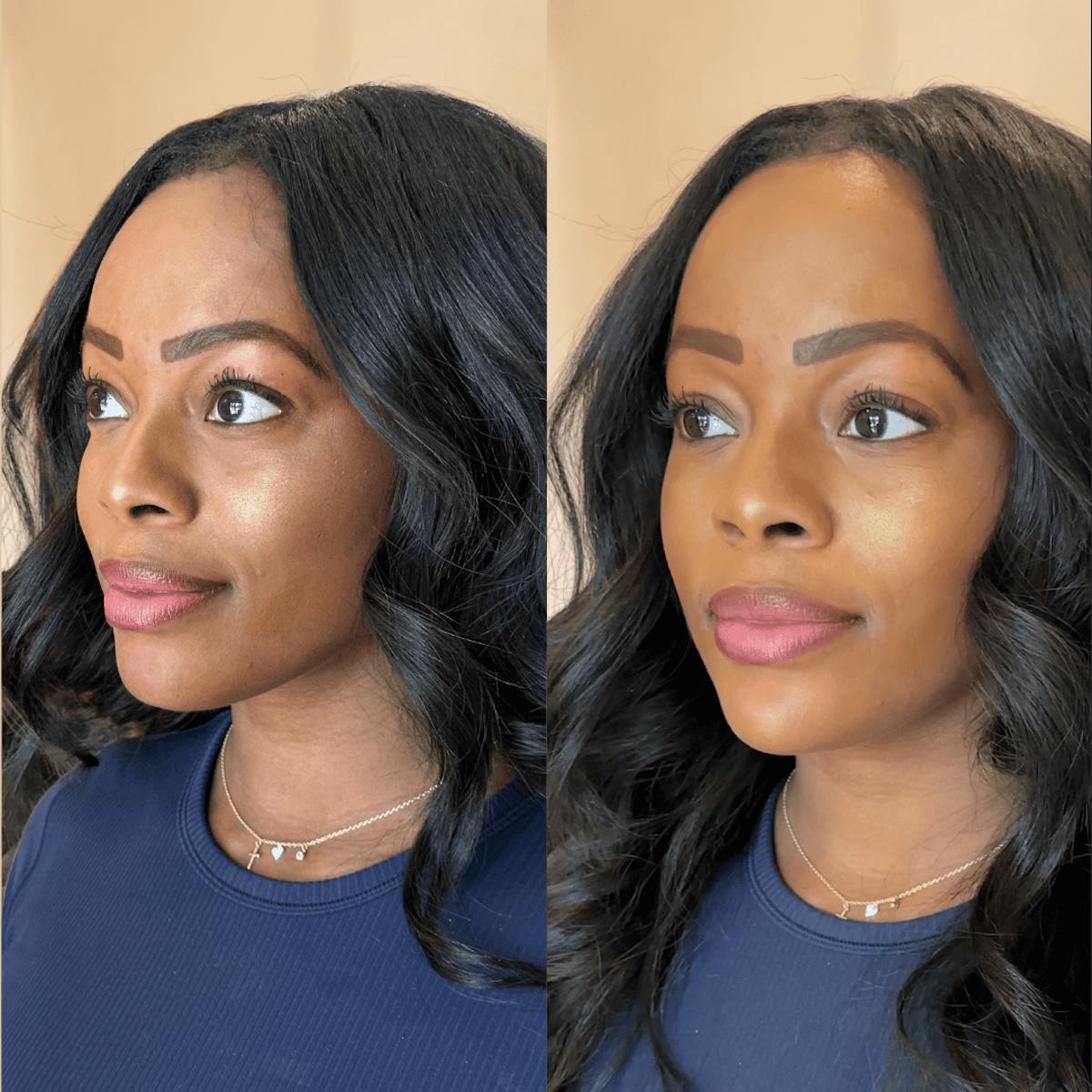 Chin Before & After Gallery - Patient 374974 - Image 9