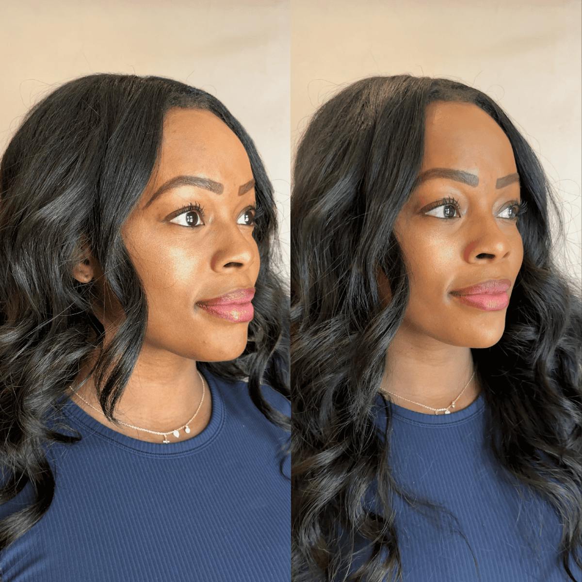 Chin Before & After Gallery - Patient 374974 - Image 6