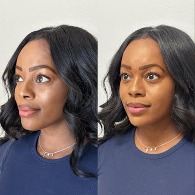 Chin Before & After Gallery - Patient 374974 - Image 1