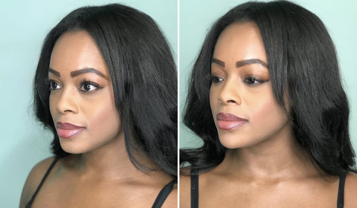 Chin Before & After Gallery - Patient 374974 - Image 7
