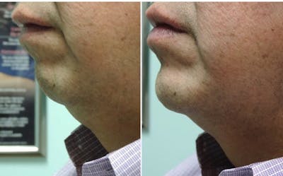 Chin Before & After Gallery - Patient 107096 - Image 1