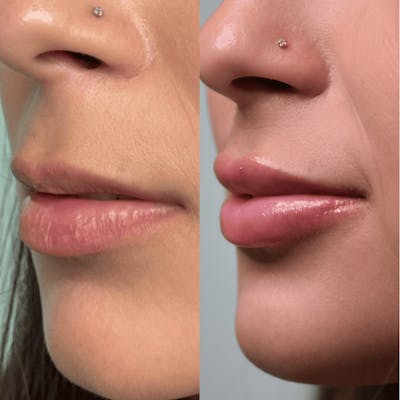 Lips Before & After Gallery - Patient 368542 - Image 1