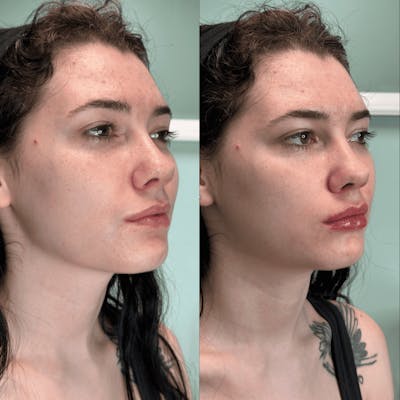 Lips Before & After Gallery - Patient 240543 - Image 1