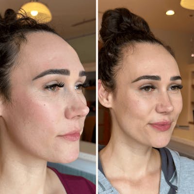 Lips Before & After Gallery - Patient 298015 - Image 1