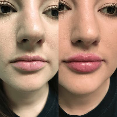 Lips Before & After Gallery - Patient 300645 - Image 1