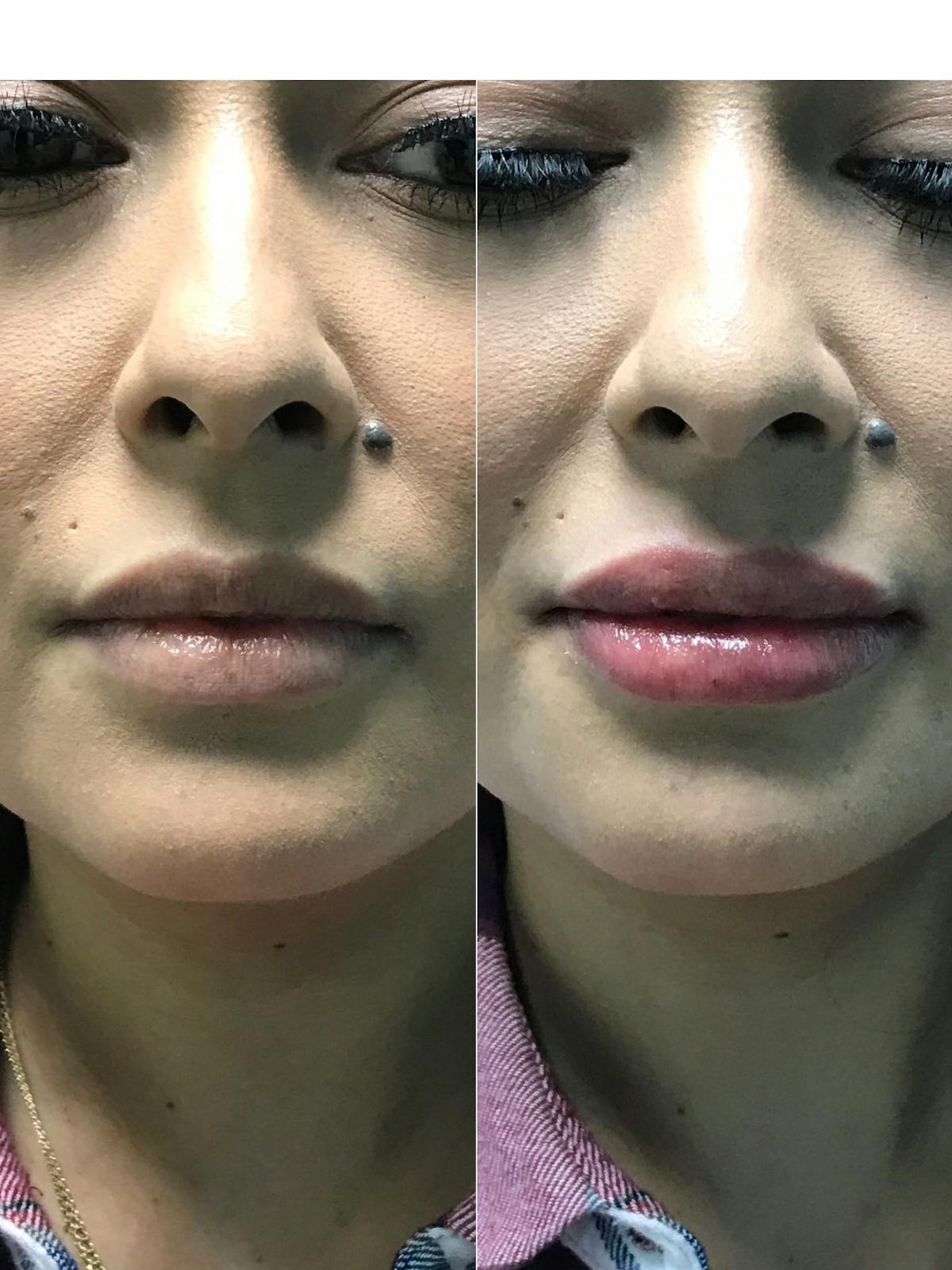 Lips Before & After Gallery - Patient 353025 - Image 2