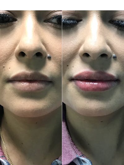 Lips Before & After Gallery - Patient 353025 - Image 1