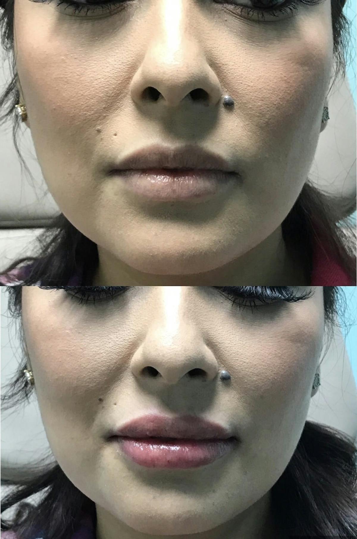 Lips Before & After Gallery - Patient 353025 - Image 1