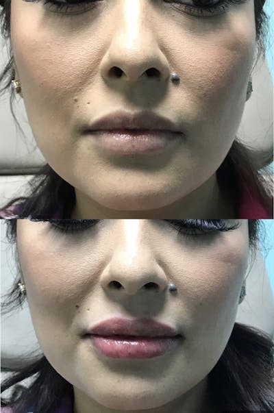Lips Before & After Gallery - Patient 353025 - Image 1