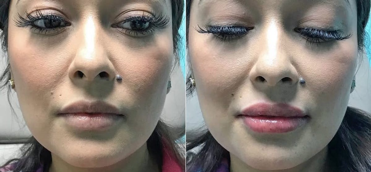 Lips Before & After Gallery - Patient 353025 - Image 3