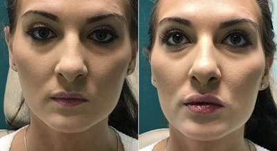 Lips Before & After Gallery - Patient 828647 - Image 1