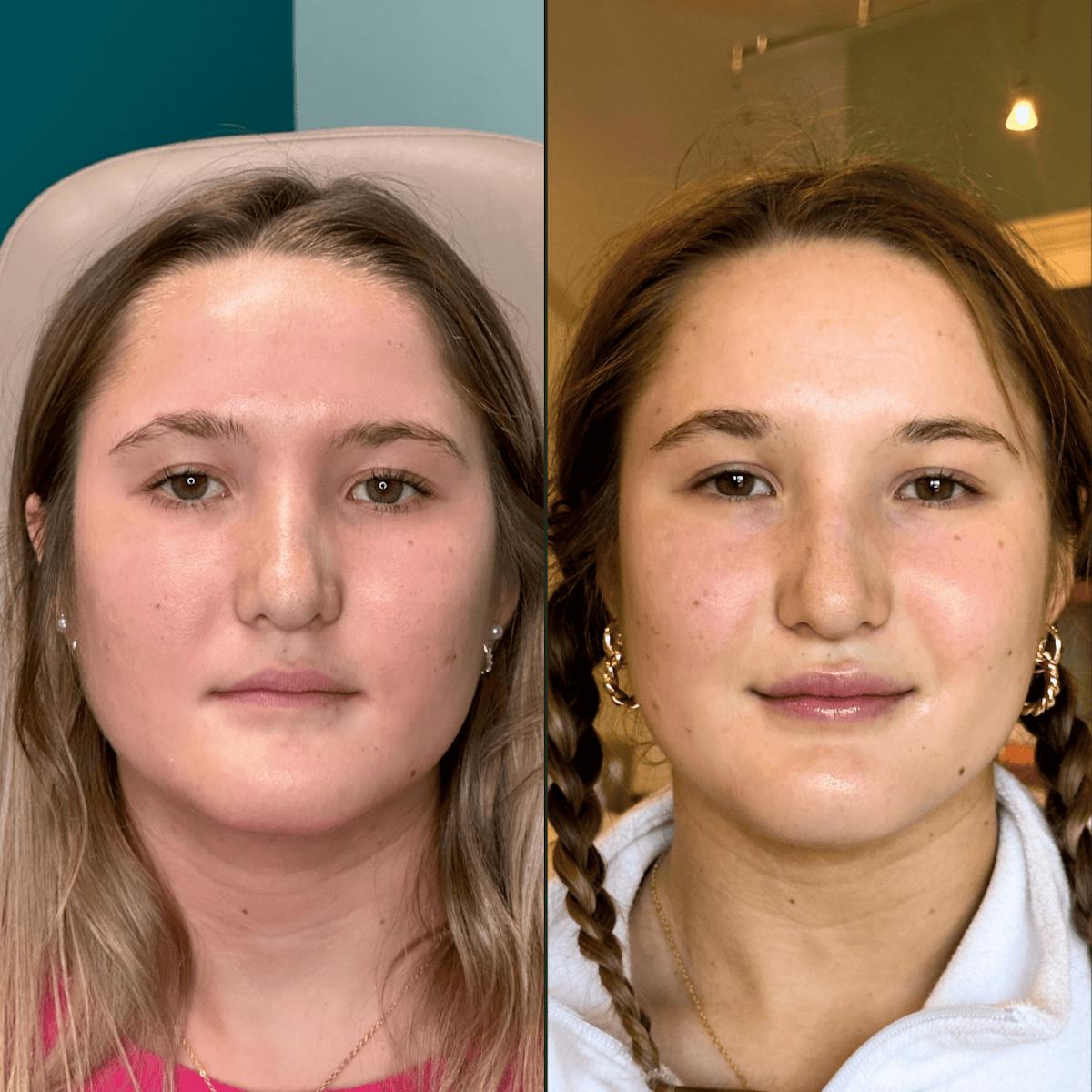 Lips Before & After Gallery - Patient 226916 - Image 5