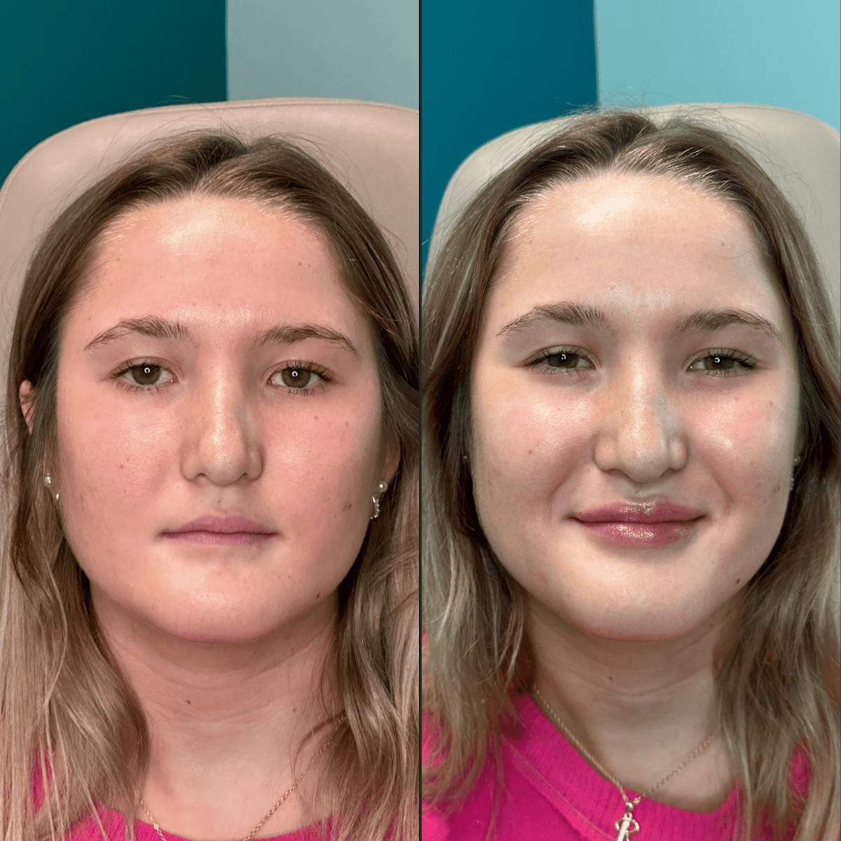 Lips Before & After Gallery - Patient 226916 - Image 6