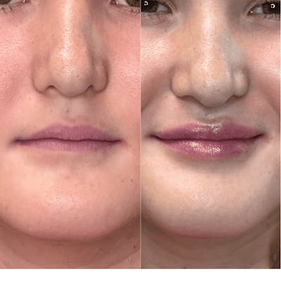 Lips Before & After Gallery - Patient 226916 - Image 1