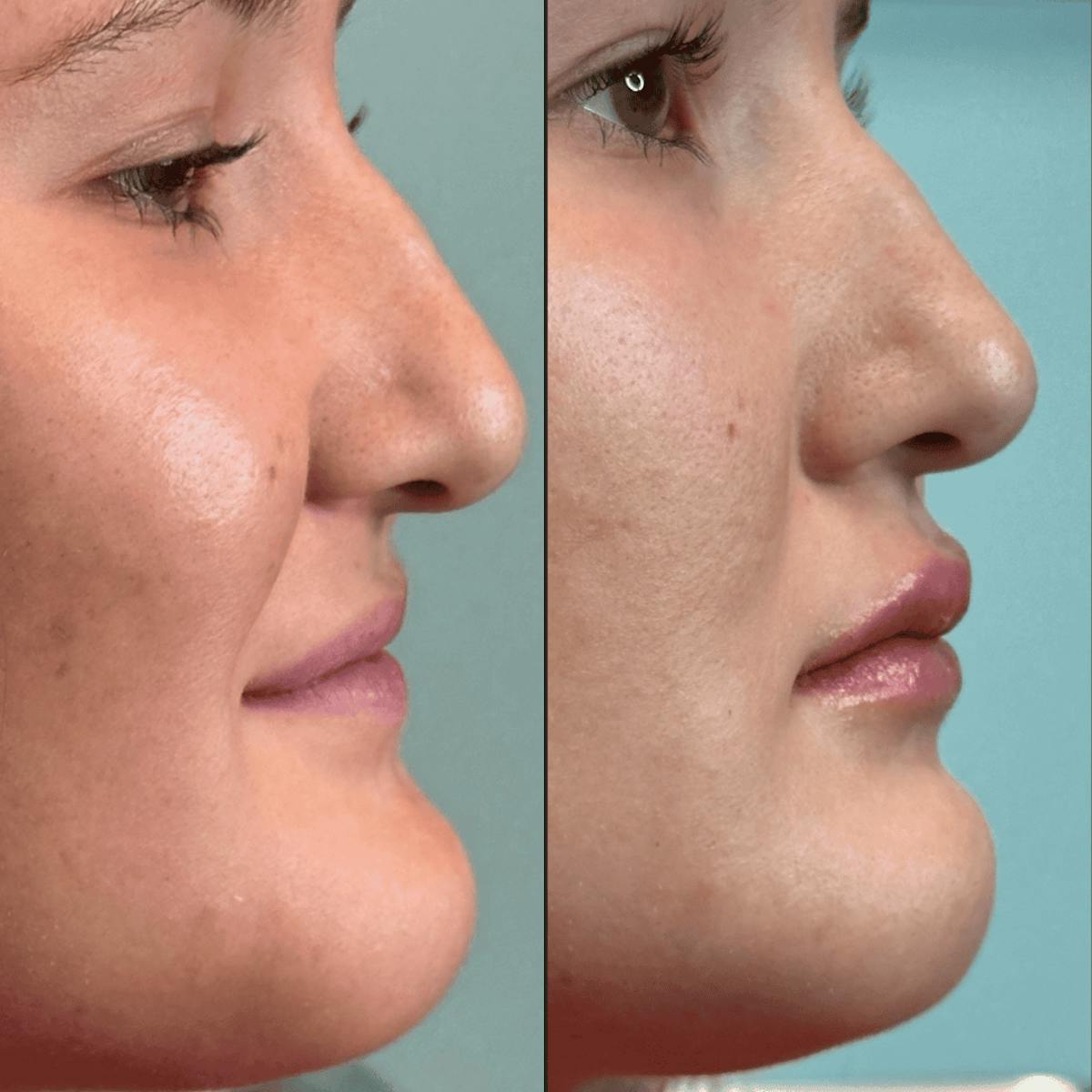 Lips Before & After Gallery - Patient 226916 - Image 7