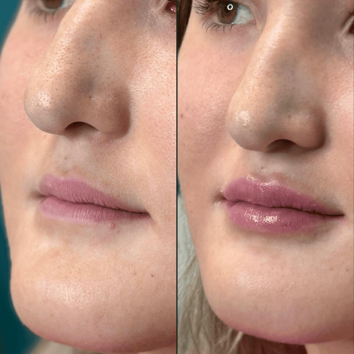 Lips Before & After Gallery - Patient 226916 - Image 3