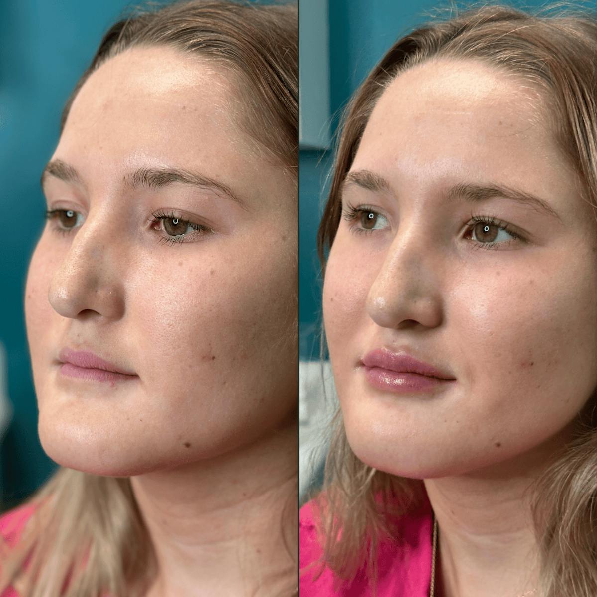 Lips Before & After Gallery - Patient 226916 - Image 4