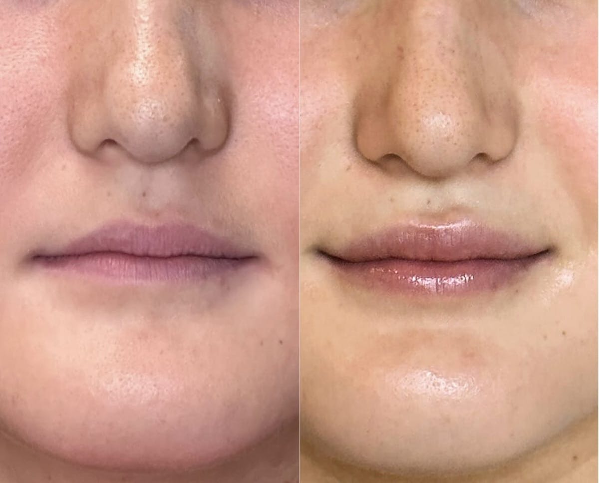 Lips Before & After Gallery - Patient 226916 - Image 2