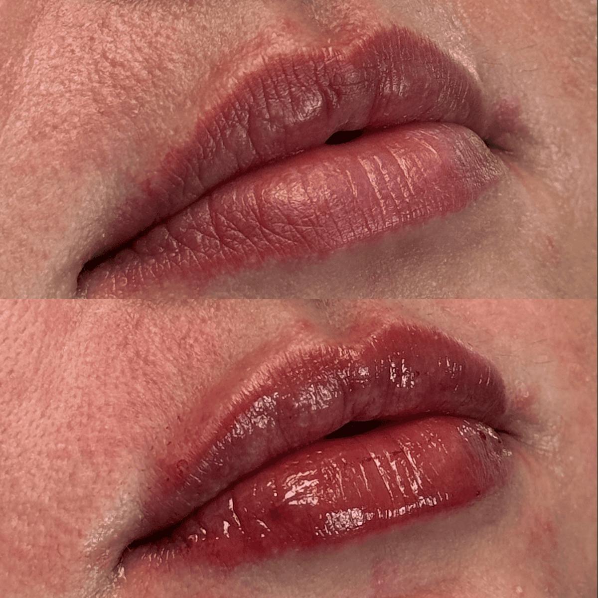 Lips Before & After Gallery - Patient 345809 - Image 3