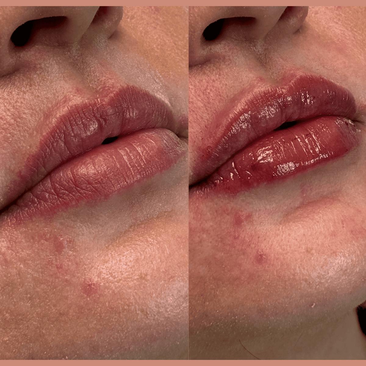 Lips Before & After Gallery - Patient 345809 - Image 2