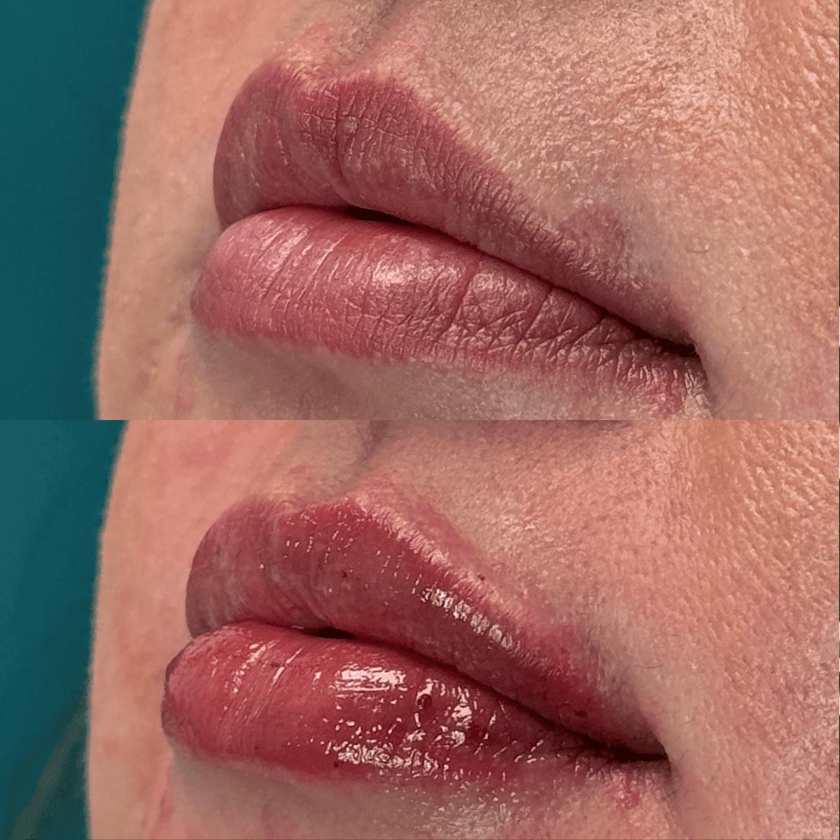 Lips Before & After Gallery - Patient 345809 - Image 9