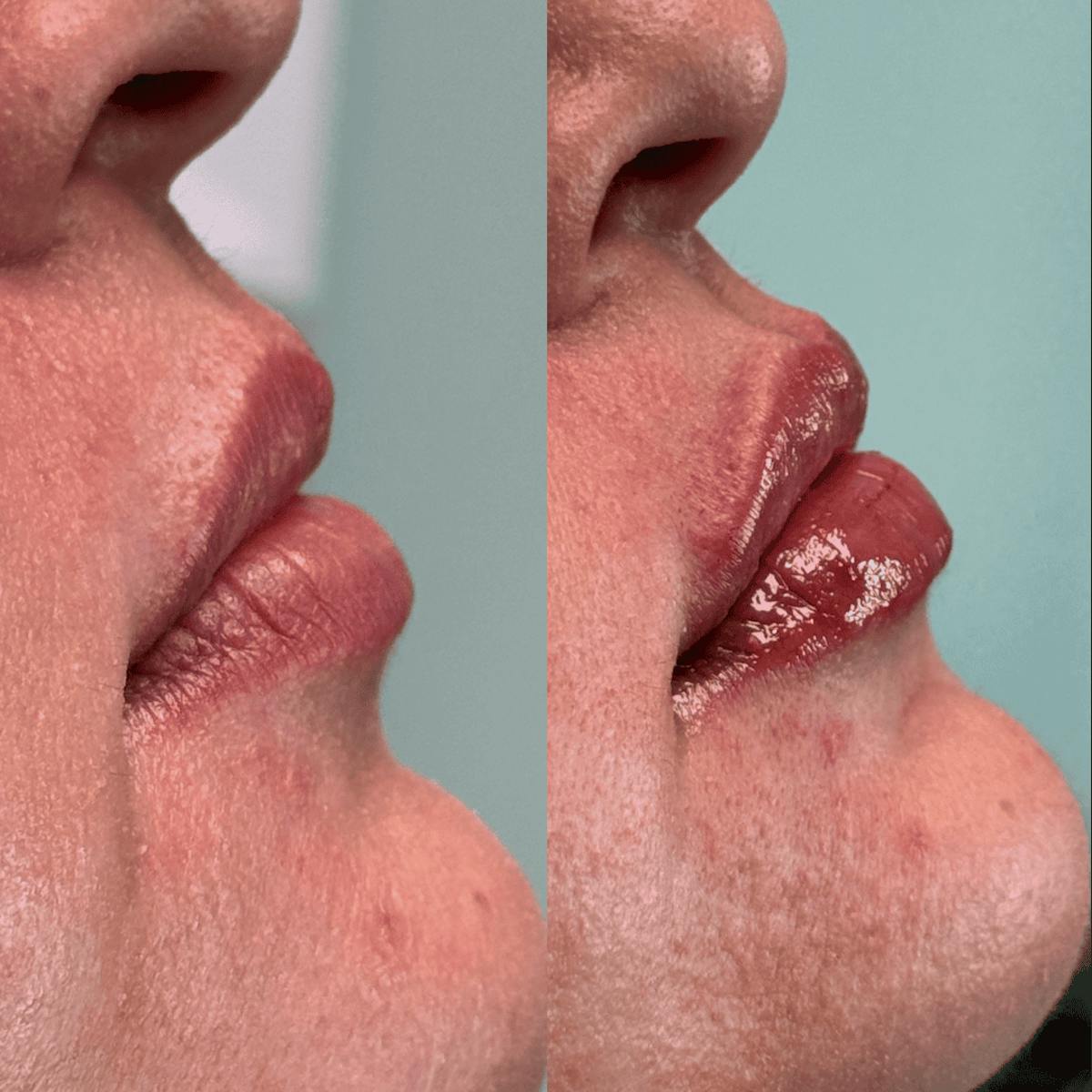 Lips Before & After Gallery - Patient 345809 - Image 8
