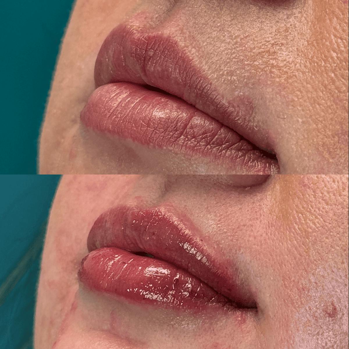 Lips Before & After Gallery - Patient 345809 - Image 5