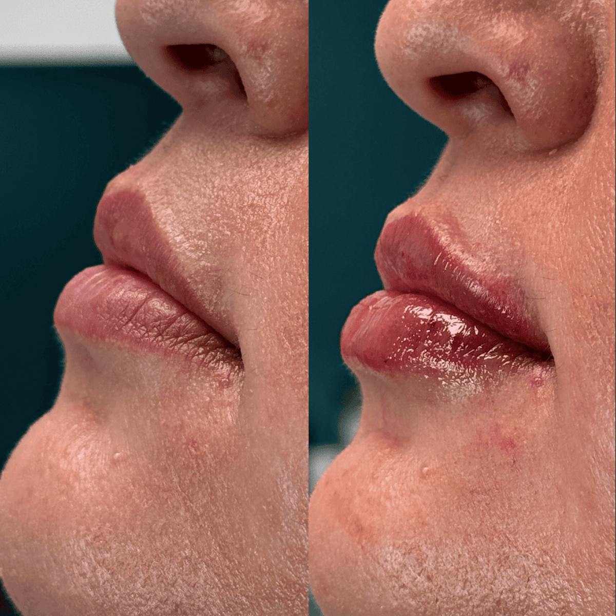 Lips Before & After Gallery - Patient 345809 - Image 6
