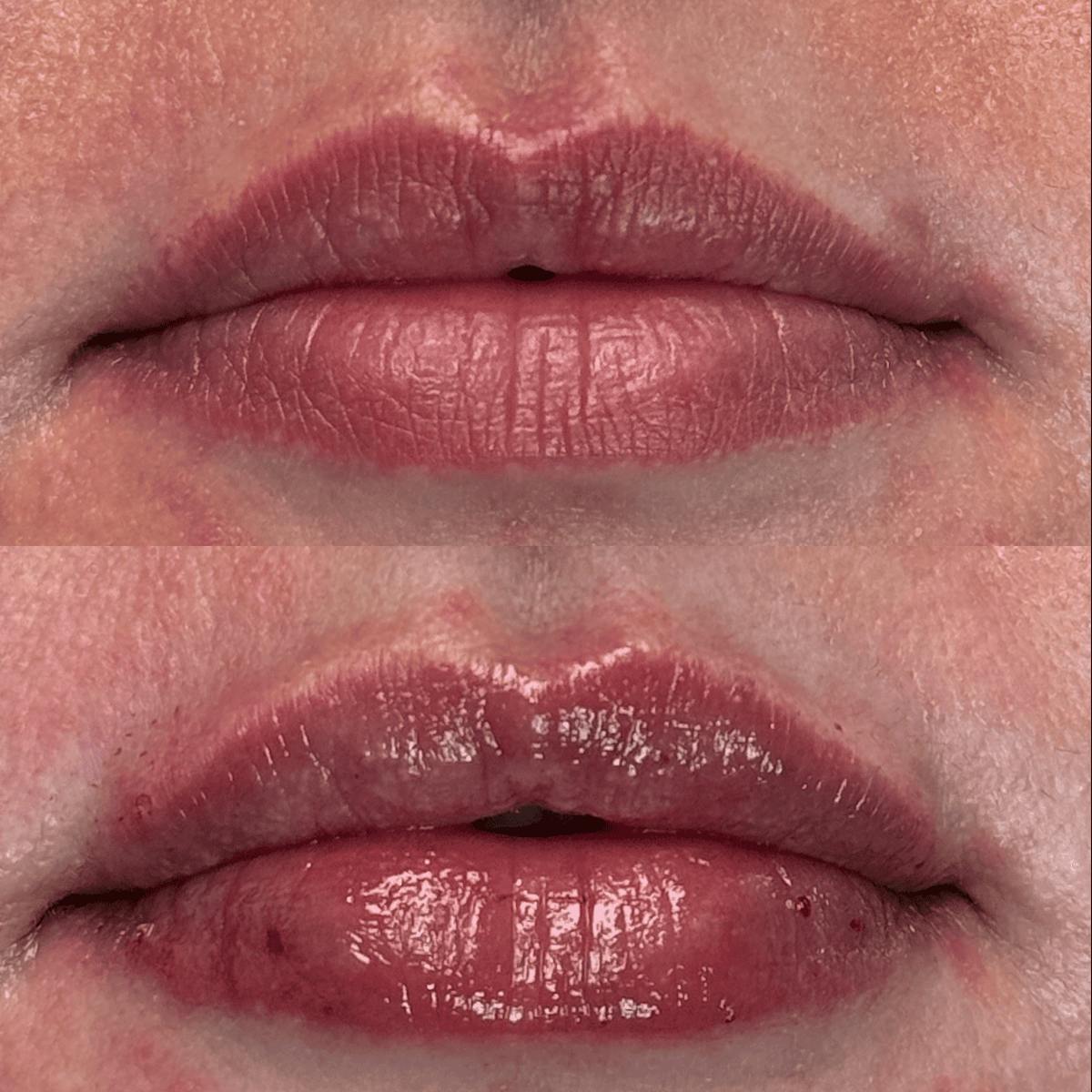 Lips Before & After Gallery - Patient 345809 - Image 7