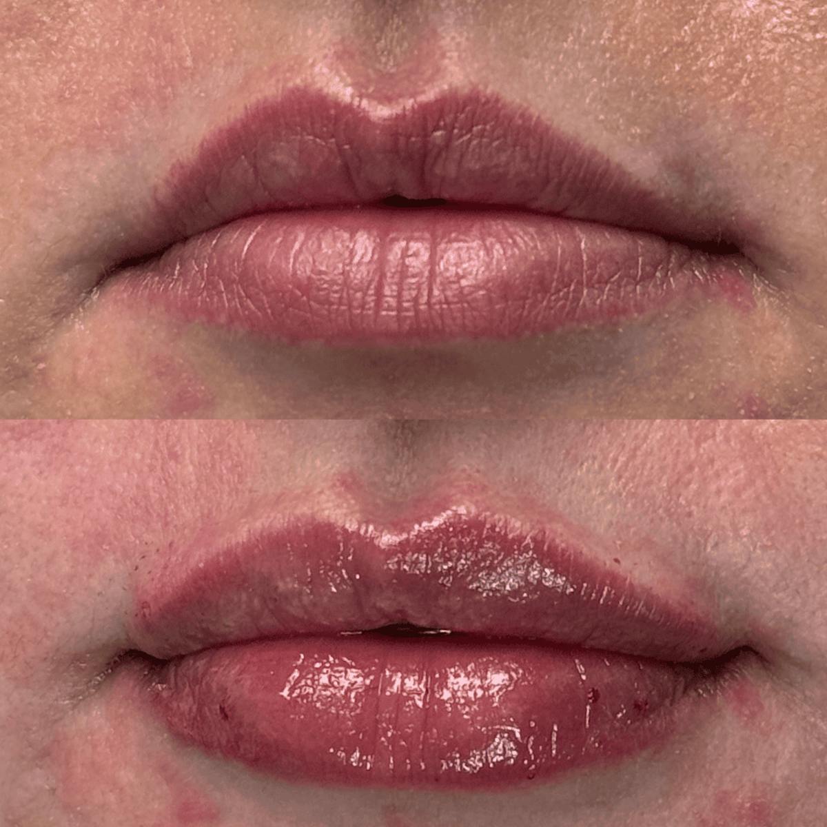 Lips Before & After Gallery - Patient 345809 - Image 4
