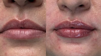Lips Before & After Gallery - Patient 345809 - Image 1