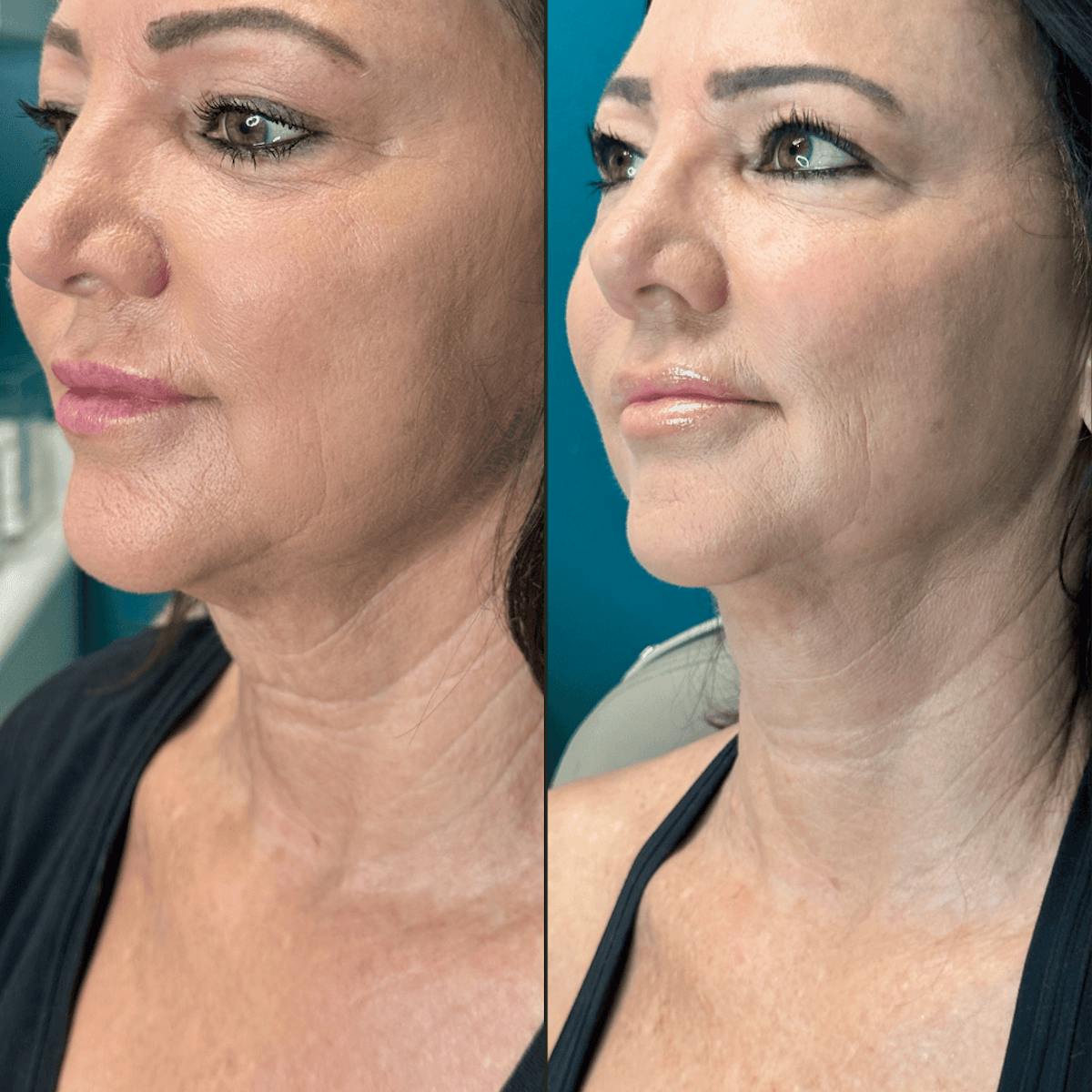 Neck Before & After Gallery - Patient 505320 - Image 3