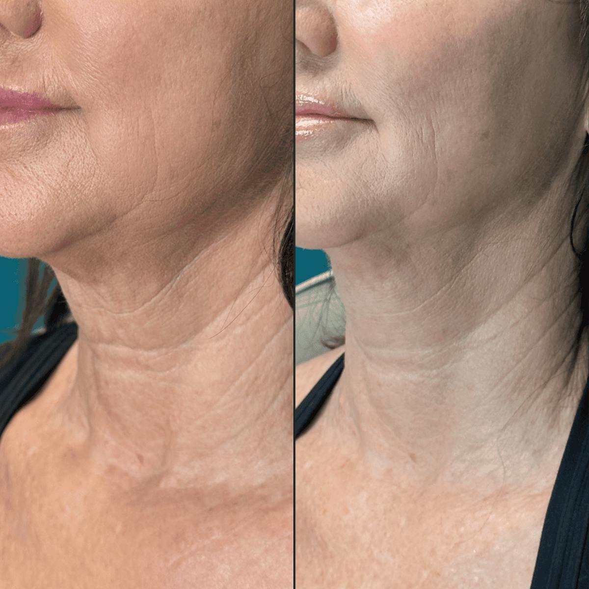 Neck Before & After Gallery - Patient 505320 - Image 5