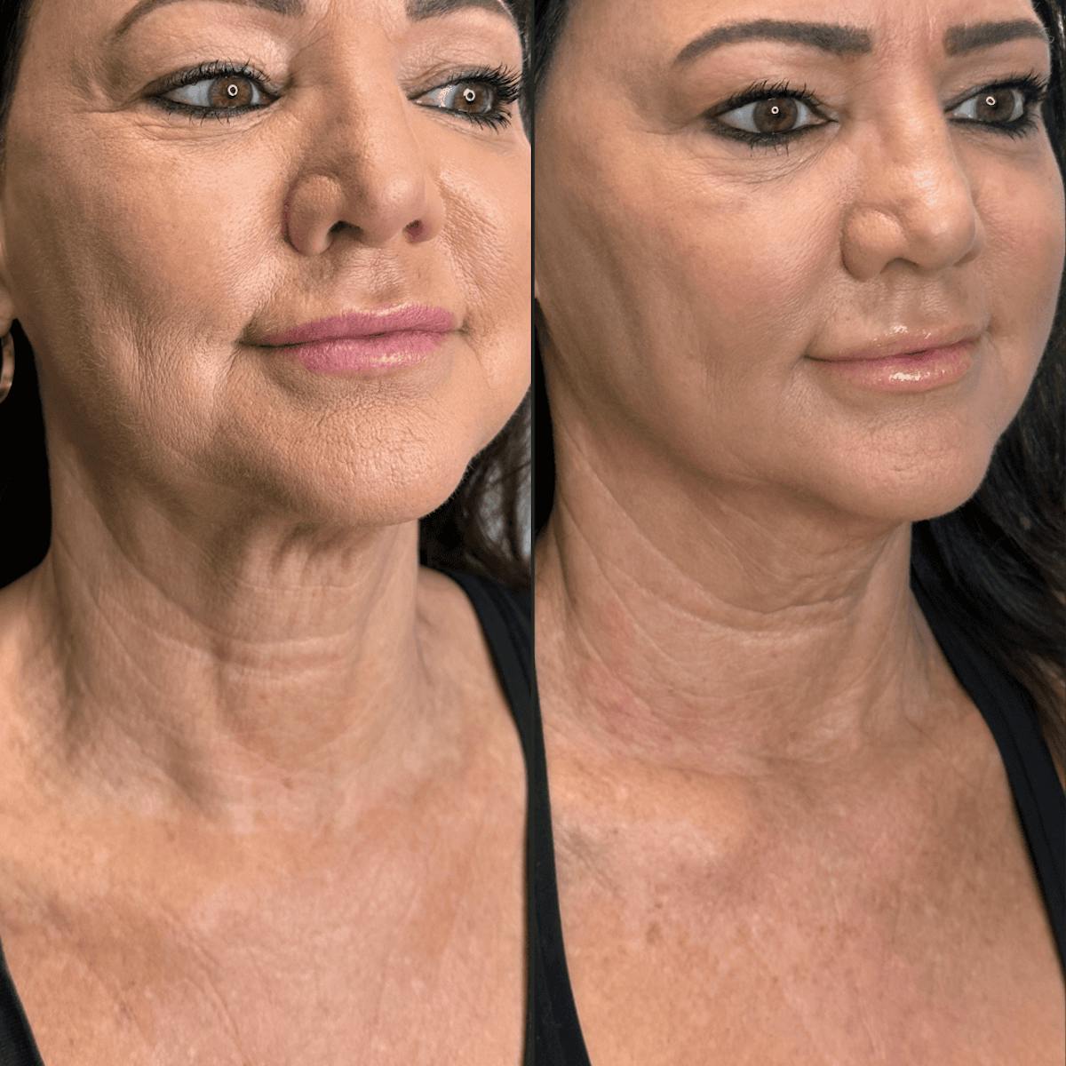 Neck Before & After Gallery - Patient 505320 - Image 15