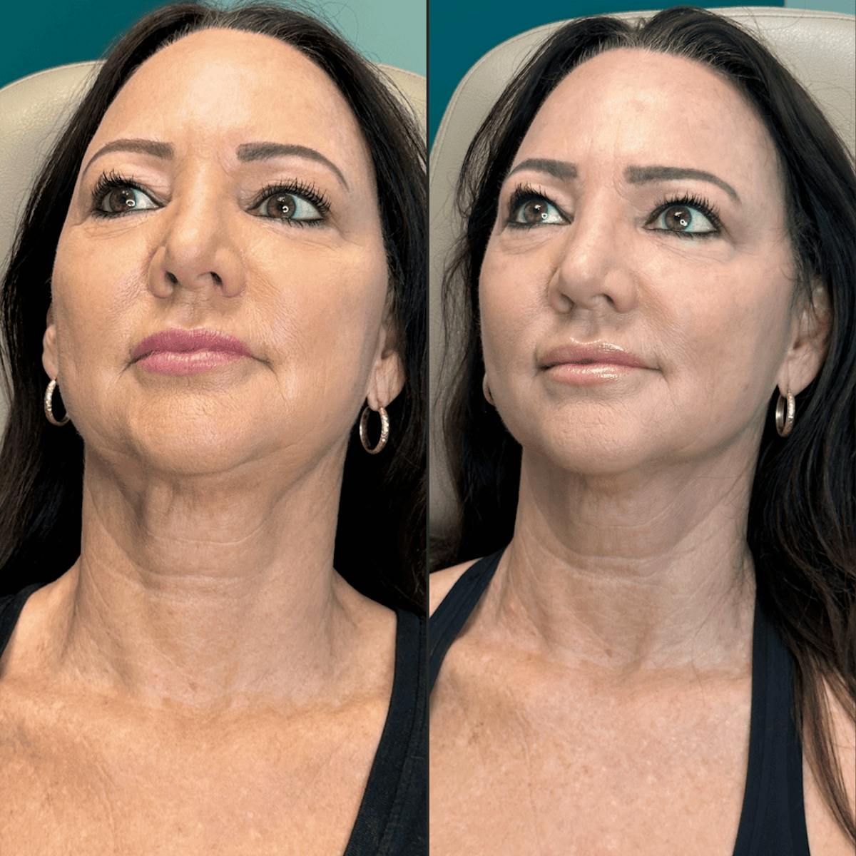 Neck Before & After Gallery - Patient 505320 - Image 13